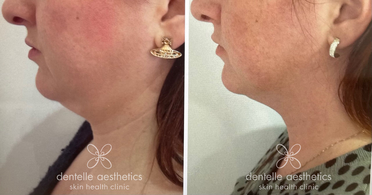 Deso Face fat dissolving for a double chin Dentelle Dentelle